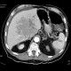 Thrombosis of mesenteric and portal vein, venous infarction of small bowel loops: CT - Computed tomography